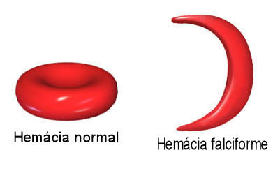 Anemia falciforme: exemplo de seleção natural na espécie humana