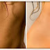 Tips For Effective Stretch Mark Removal Dubai - Laser Skin Care