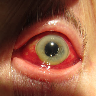 Bleeding eyes,bleeding eyes causes,bleeding eyes meaning