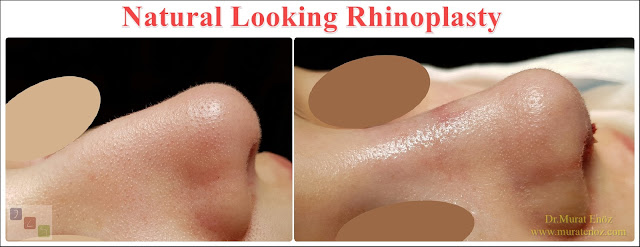 Natural Looking Rhinoplasty - Natural Nose Job - Natural Rhinoplasty - Female Nose Aesthetic Surgery - Nose Jobs For Women - Nose Reshaping for Women - Best Rhinoplasty For Women Istanbul - Female Rhinoplasty Istanbul - Nose Job Surgery for Women - Women's Rhinoplasty - Nose Aesthetic Surgery For Women - Female Rhinoplasty Surgery in Istanbul - Female Rhinoplasty Surgery in Turkey