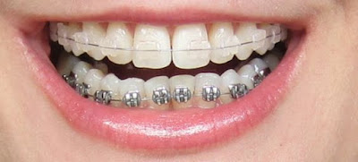 Quy trình niềng răng hàm dưới an toàn