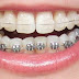 Quy trình niềng răng hàm dưới an toàn