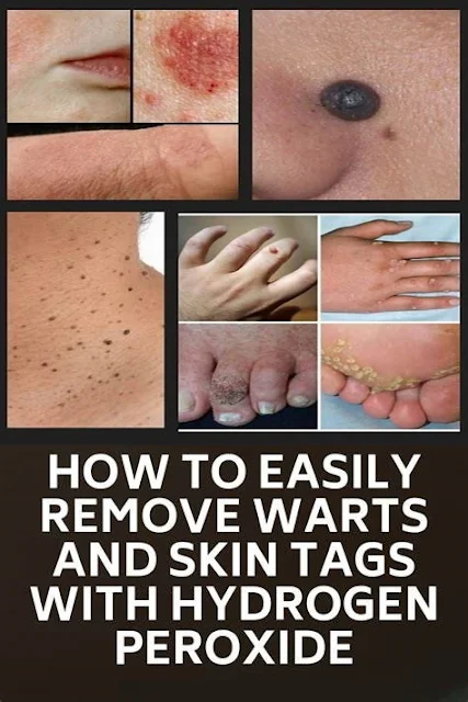 How to Easily Remove Moles and Warts with Hydrogen Peroxide (and stop them from coming back) !