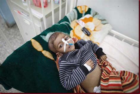 anak Yaman Kurang Gizi sedangkan disekitar jazirah arab ada Banyak Negara Yang begelimang  Ironis, Anak-anak Yaman Kurang Gizi