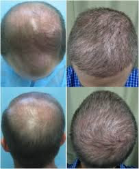 hair loss treatment