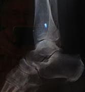 Momma's Broken Leg (img )