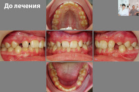 Зубы пациента до  лечения брекетами