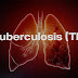 Tuberculosis (TB) Awareness: Signs, Prevention, and Effective Treatment