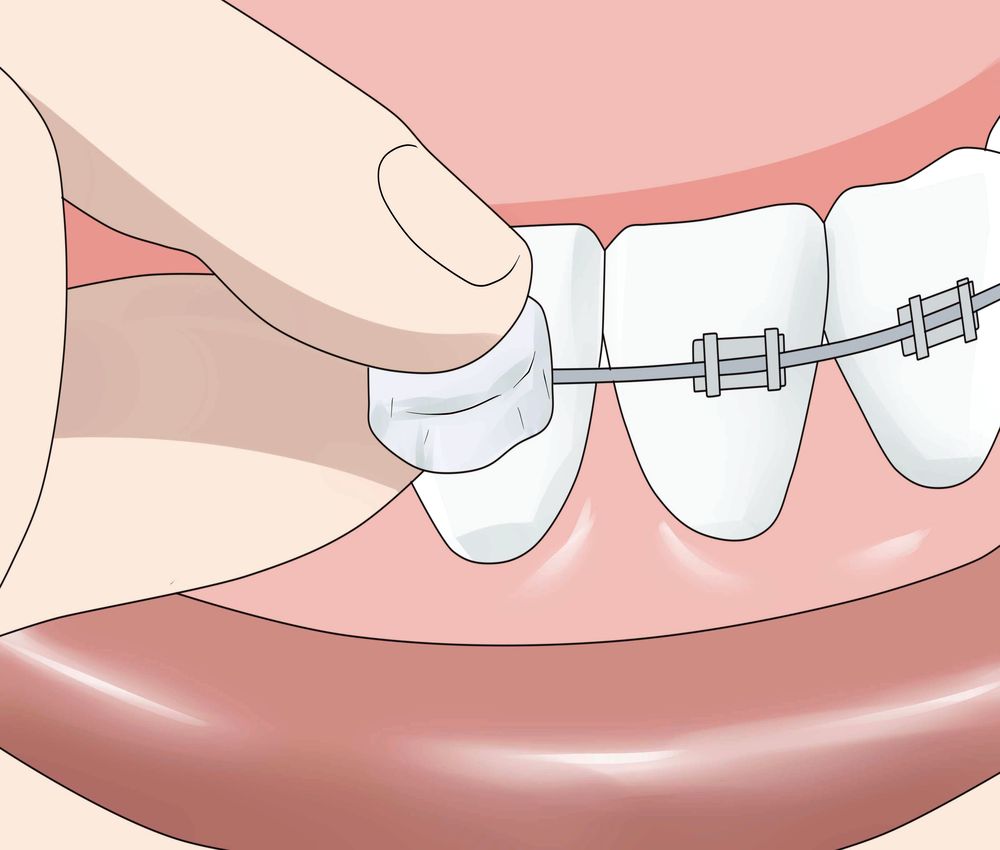 ORTHODONTIC How to Apply Dental Wax on Braces