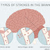 Major causes of stroke 