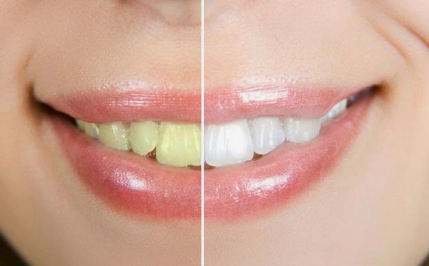 Cara Mudah Memutihkan Gigi Dengan Garam Dapur dan Jeruk Nipis Cara Mudah Memutihkan Gigi Dengan Garam Dapur dan Jeruk Nipis
