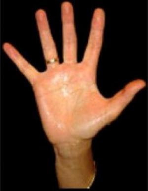 Palmar Hyperhidrosis Treatments, Palmar Hyperhidrosis Symptoms, Palmar Hyperhidrosis Cures