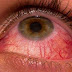 Pink eyes Herble Home Remedies ( Pink eyes Symptoms and Cause )
