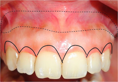 Tư vấn từ nha sĩ viêm lợi nên uống thuốc gì?-1