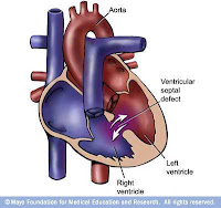 Ventrikular Septal Defek (VSD), Blog Keperawatan