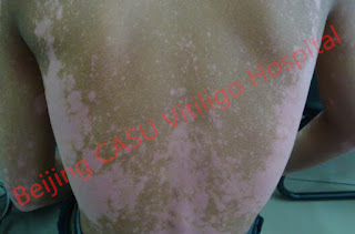 Vitiligo Treatment At Home