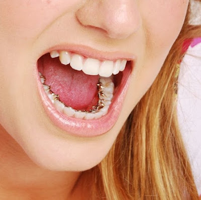 Quy trình niềng răng mặt lưỡi