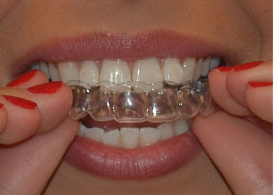 Niềng răng không mắc cài 3D