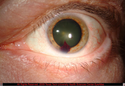 Blood In The Eye: Managing Hyphema - Eyedolatry