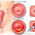 Biểu hiện bệnh viêm cổ tử cung