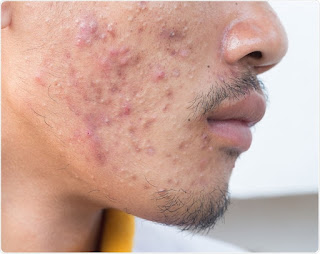 como quitar el acne en hombres