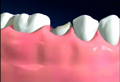 Khắc phục răng sâu bị mẻ thế nào?