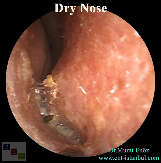 Dry Nose