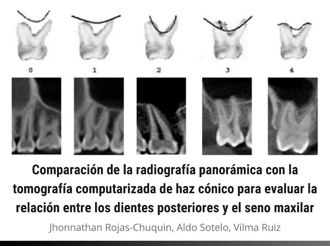 PDF: Comparación de la Radiografía Panorámica con la Tomografía Computarizada de Haz Cónico para evaluar la relación entre los dientes posteriores y el seno maxilar