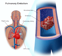 Pulmoner Tromboemboli