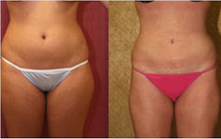 liposuction before and after pictures