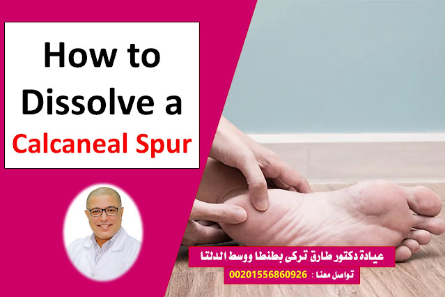 Learn how to dissolve a Calcaneal Spur