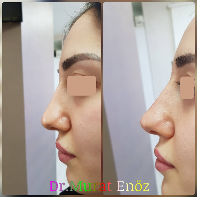 Non-surgical rhinoplasty in Istanbul - The 5 Minute Nose Job in İstanbul - Non-surgical nose job - Nose filler injection Turkey - Injectable nose job - Liquid rhinoplasty