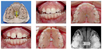 Răng hô có cần niềng răng không ?
