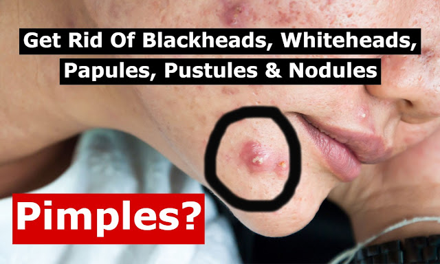 Get Rid Of Blackheads, Whiteheads, Papules, Pustules & Nodules 2023 thumbnail