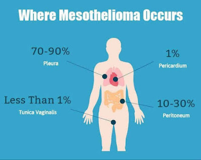 Types of Mesothelioma