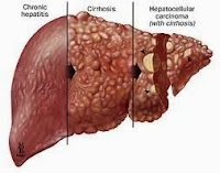 Cara Alami Menyembuhkan Penyakit Liver