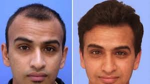 http://hairtransplant.org.pk/