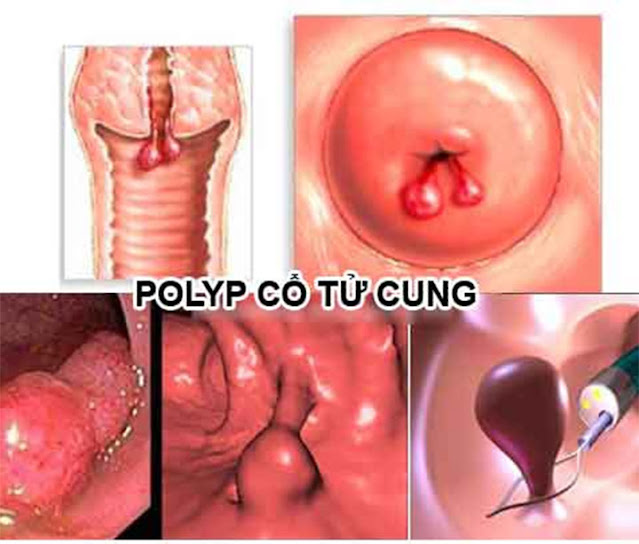 Thế nào là bệnh polyp cổ tử cung