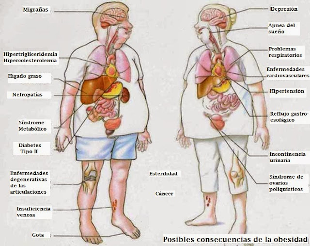 riesgos de la obesidad