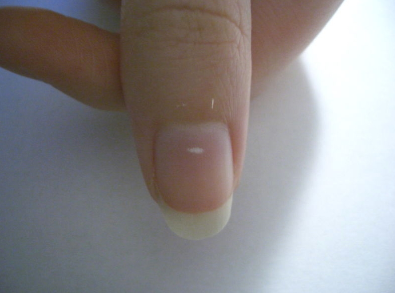 What Does White Spots On Your Nails Mean