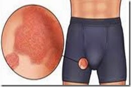 Rash in groin area treatment and causes