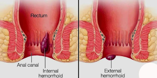 Best ayurvedic medicine for piles - Dr. Piles Free