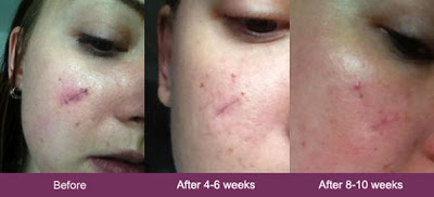 mederma before and after face scar