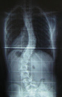 Scoliosis Causes, Signs and Symptoms