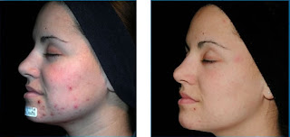 acne rosacea tratamiento natural