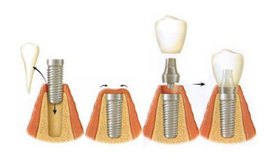 Lưu ý khi cấy ghép implant