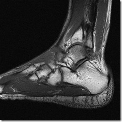 tib-fib2