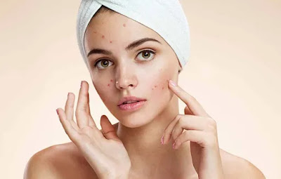 inilah masker alami yang cocok untuk wajah berjerawat