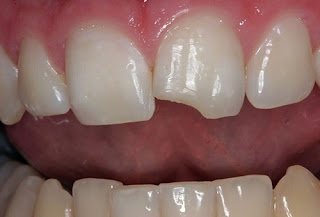 Răng cửa bị mẻ phải làm sao khắc phục?
