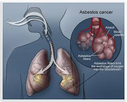 Asbestos Diseases & Cancer